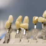 Nowoczesna technika stosowana w salonach stomatologii estetycznej być może spowodować, że odzyskamy śliczny uśmieszek.